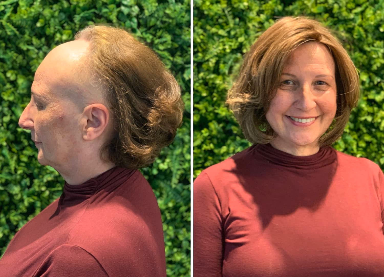 Prótese capilar feminina com densidade personalizada e volume